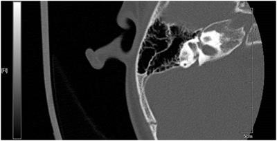 Characteristics of large vestibular aqueduct syndrome in wideband acoustic immittance